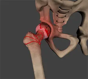 Avasküler Nekroz (Osteonekroz) Nedir? Belirtileri Nelerdir?
